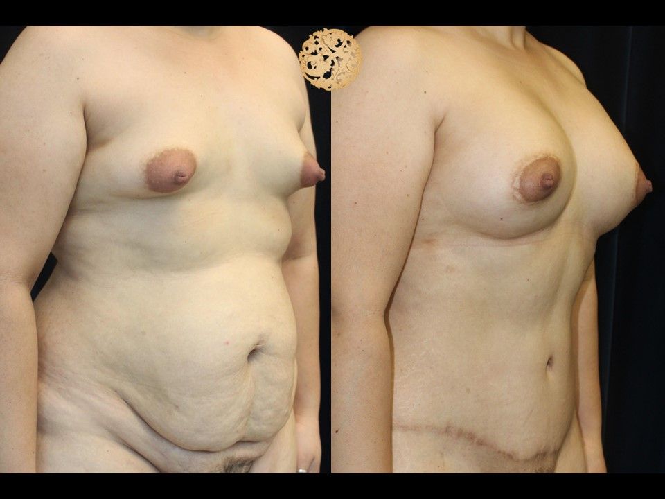 Mommy Makeover Before & After