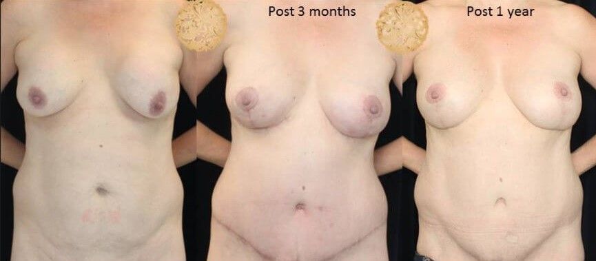 Mommy Makeover Before & After