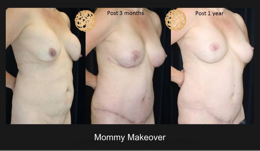 Mommy Makeover Before & After