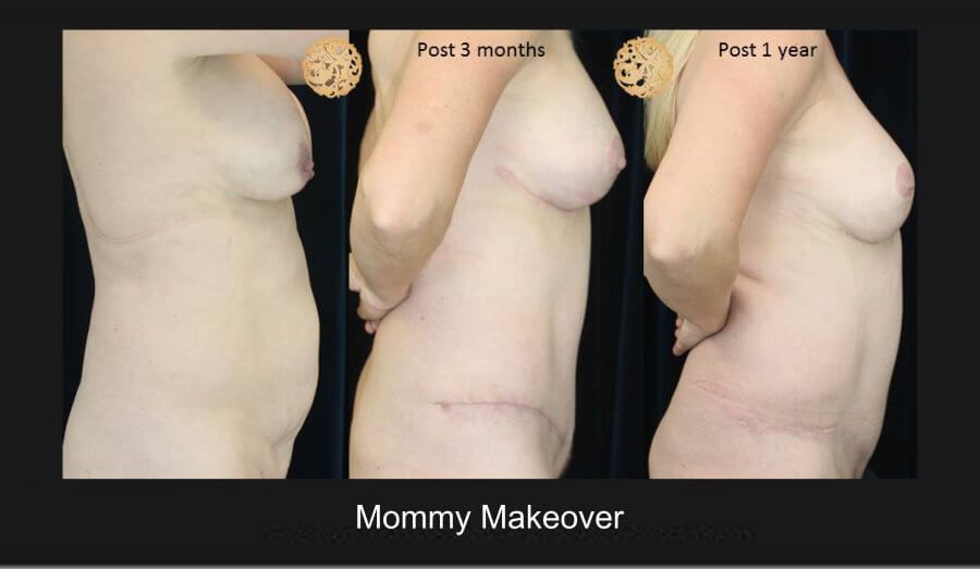 Mommy Makeover Before & After
