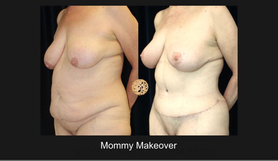 Mommy Makeover Before & After