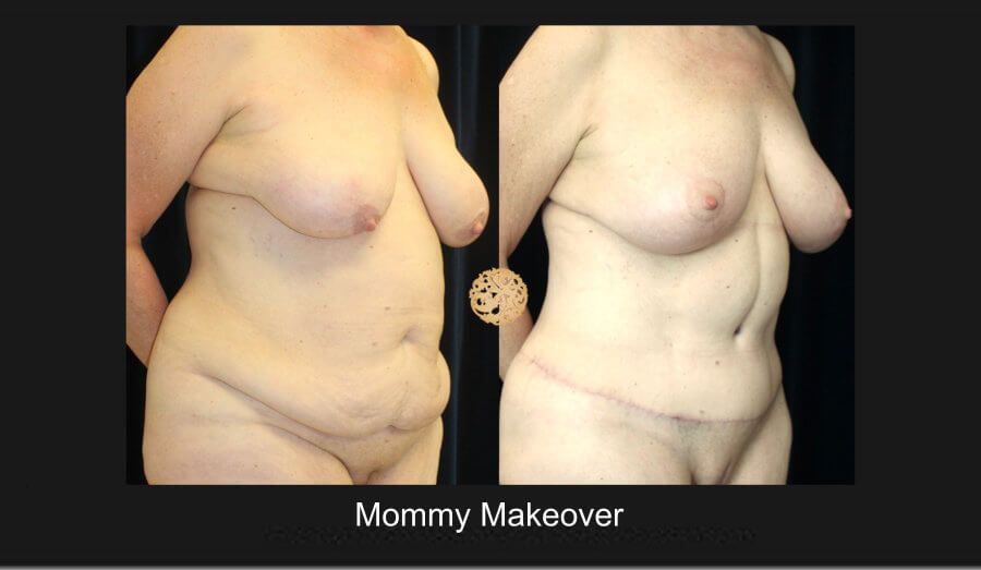 Mommy Makeover Before & After