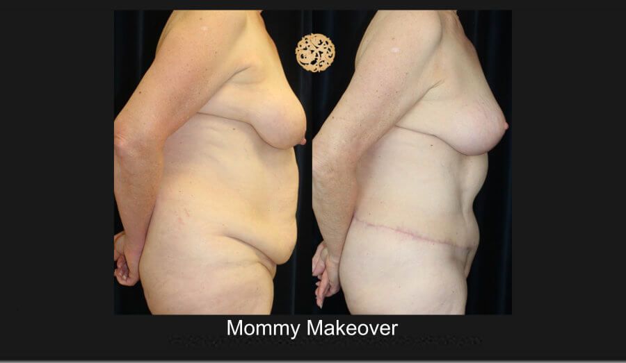 Mommy Makeover Before & After