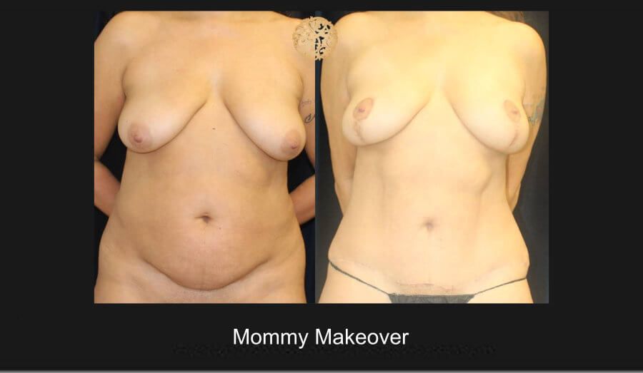 Mommy Makeover Before & After