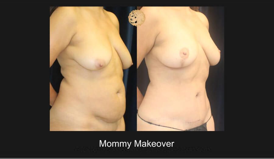 Mommy Makeover Before & After