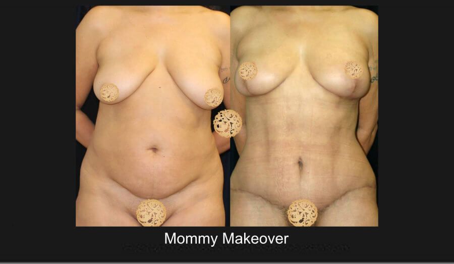 Mommy Makeover Before & After