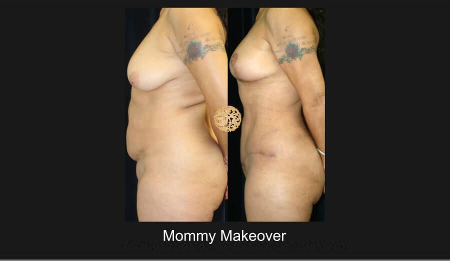 Mommy Makeover Before & After