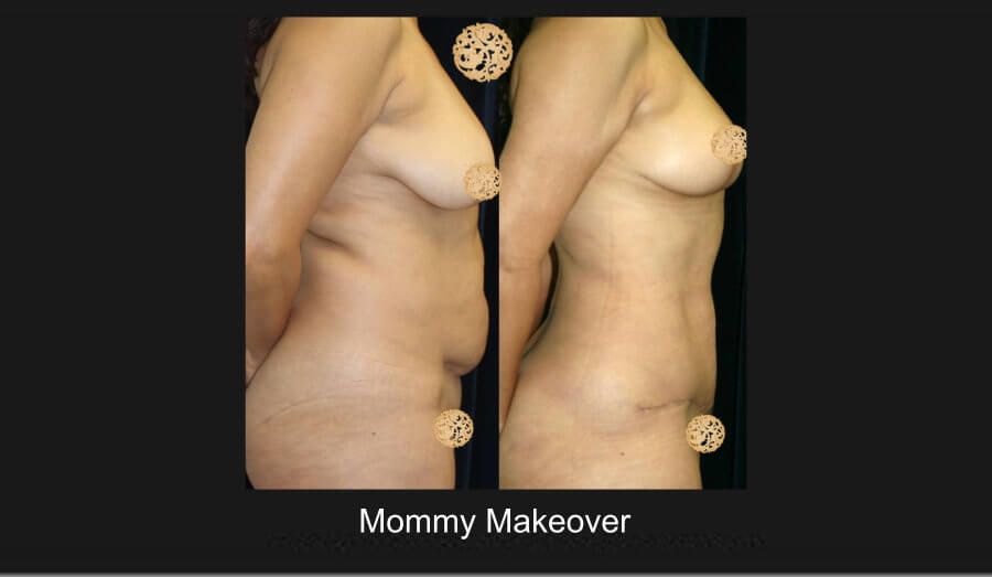 Mommy Makeover Before & After