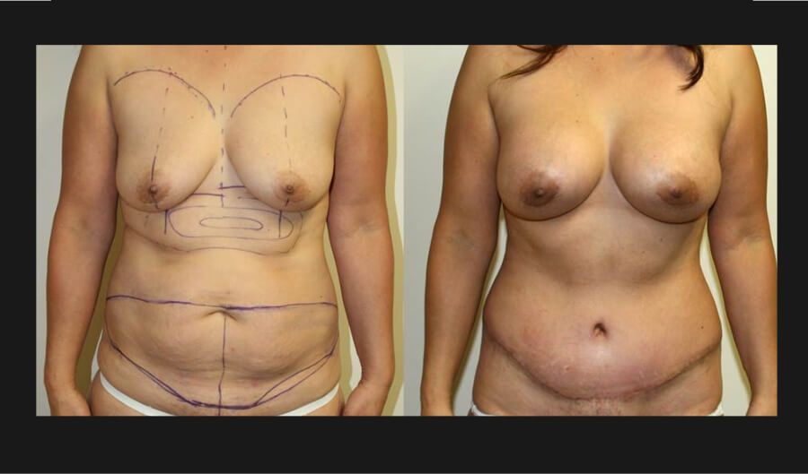 Mommy Makeover Before & After