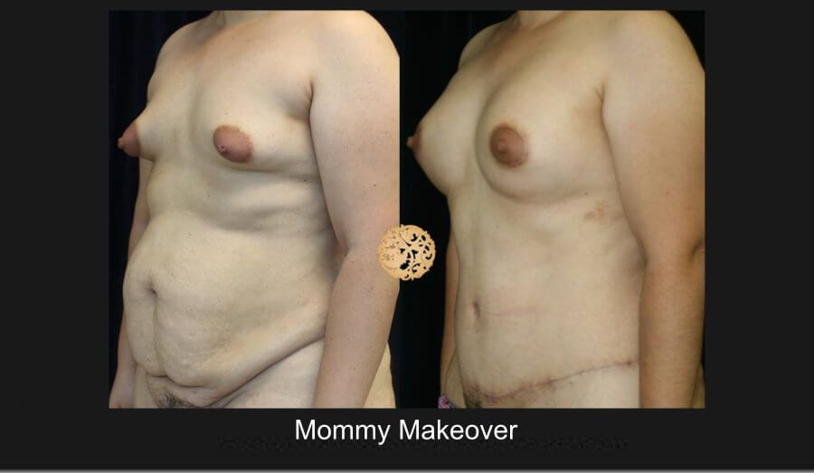 Mommy Makeover Before & After