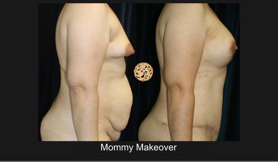 Mommy Makeover Before & After