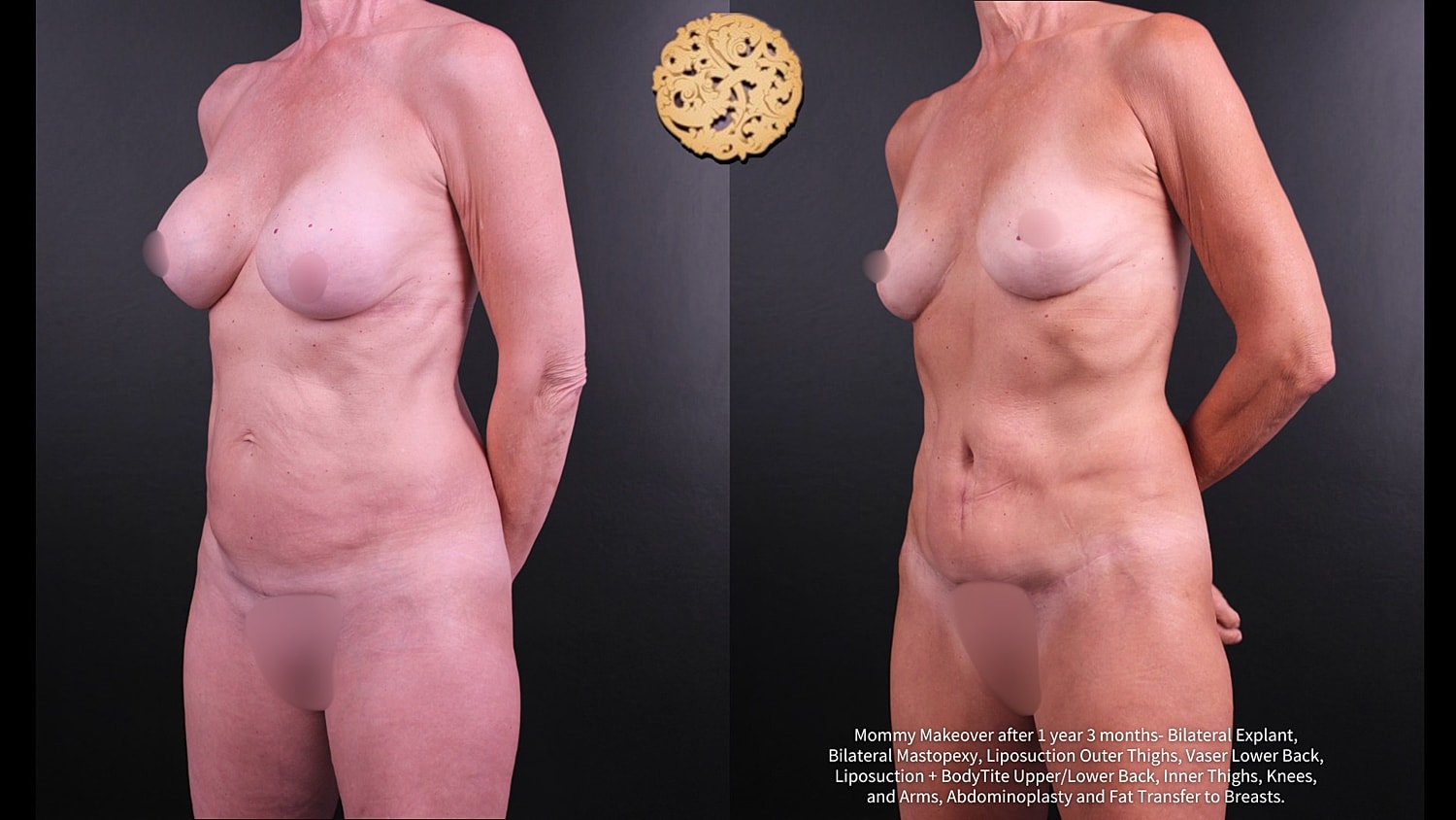 Mommy Makeover Before & After