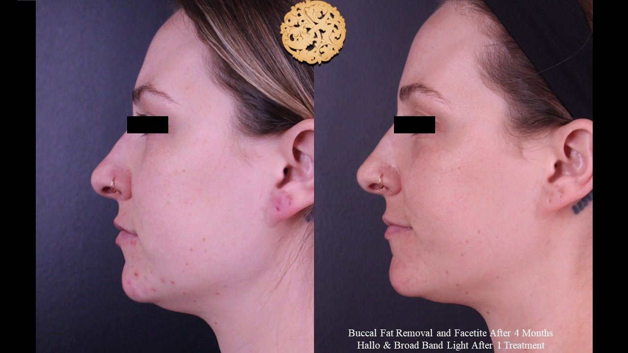 BBL Laser Acne Before & After