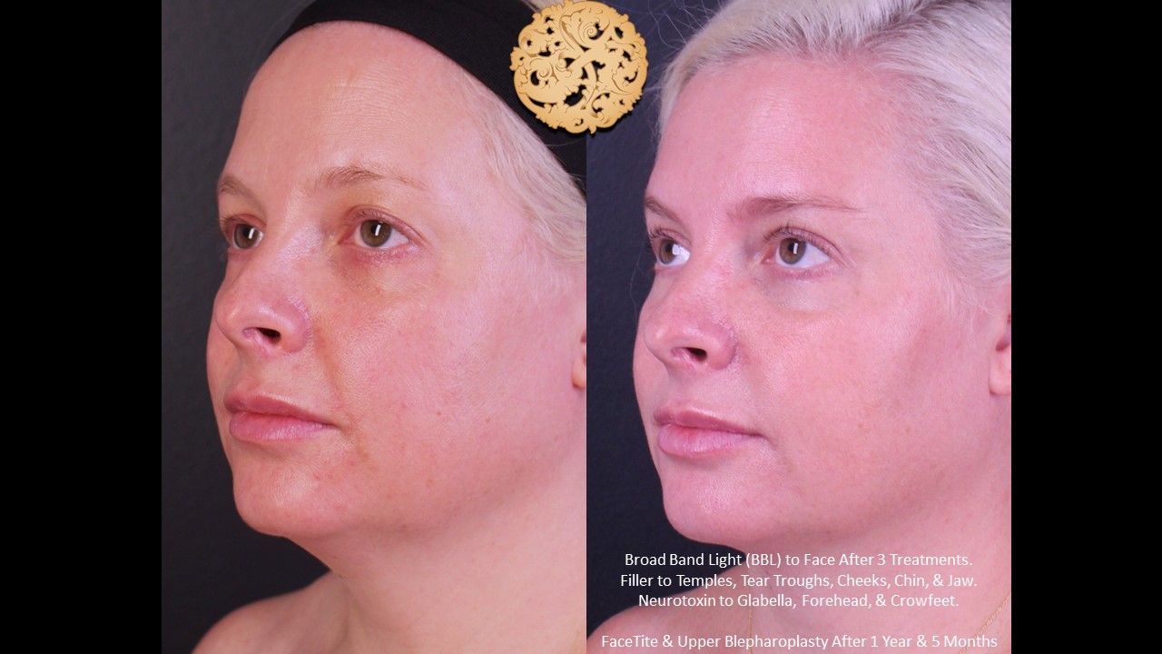 BBL Laser Acne Before & After