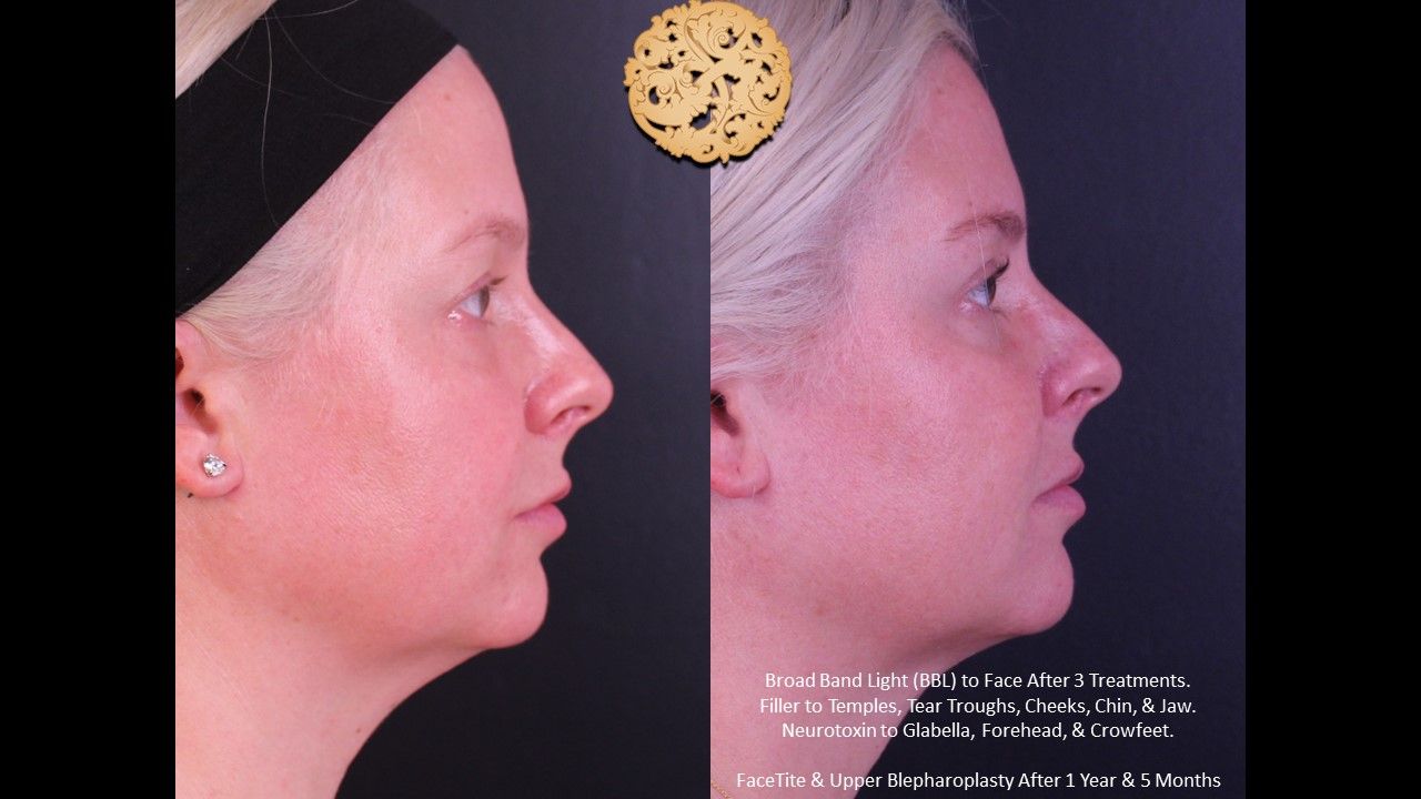 Bbl Laser Acne Before & After