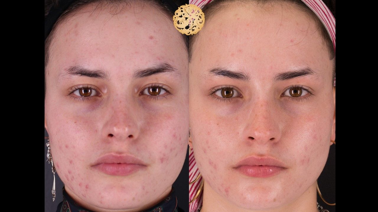 Bbl Laser Acne Before & After