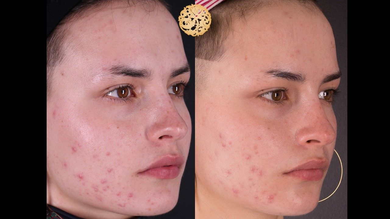 Bbl Laser Acne Before & After