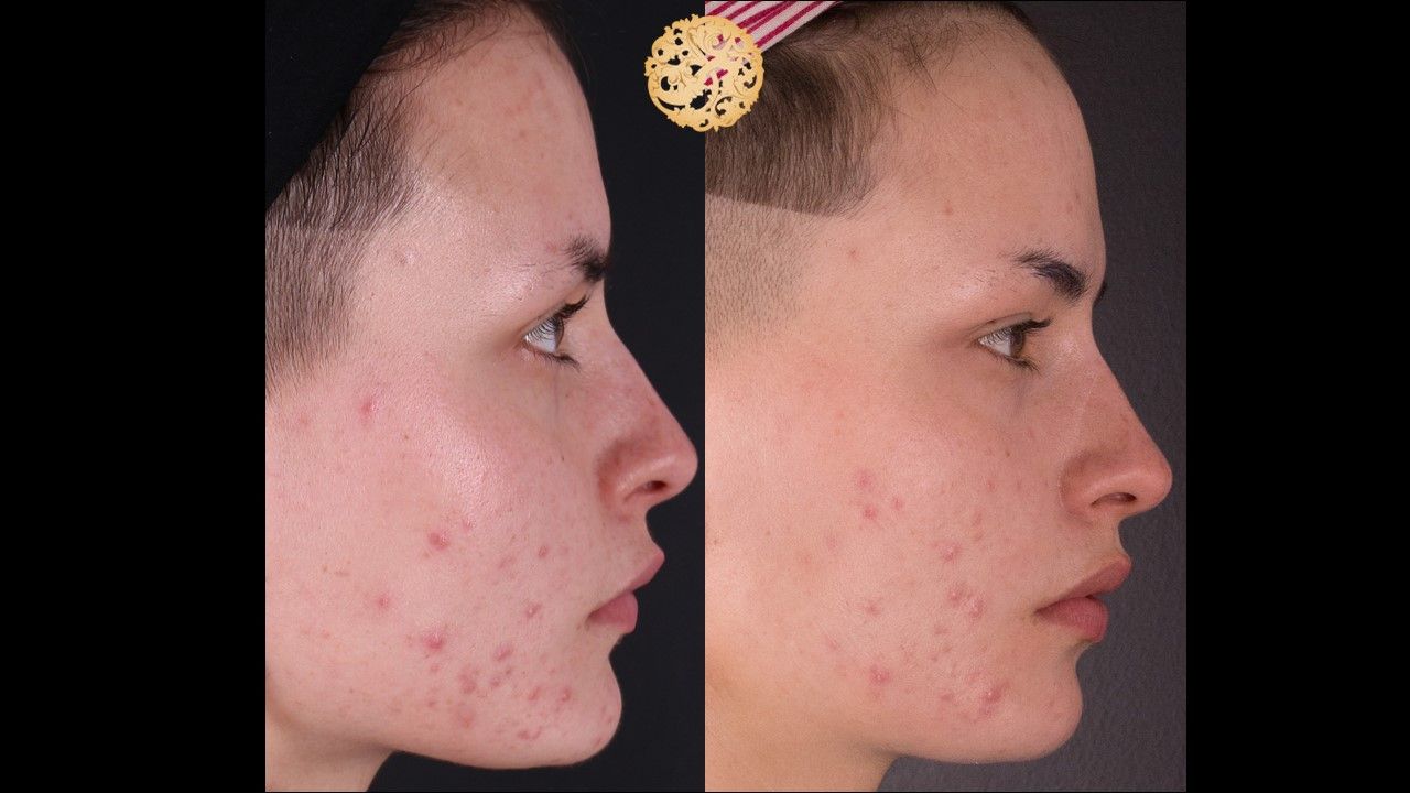 Bbl Laser Acne Before & After