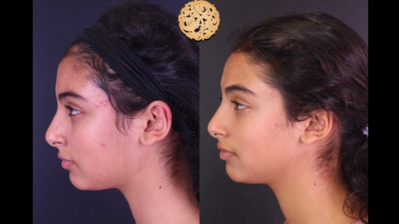 BBL Laser Acne Before & After