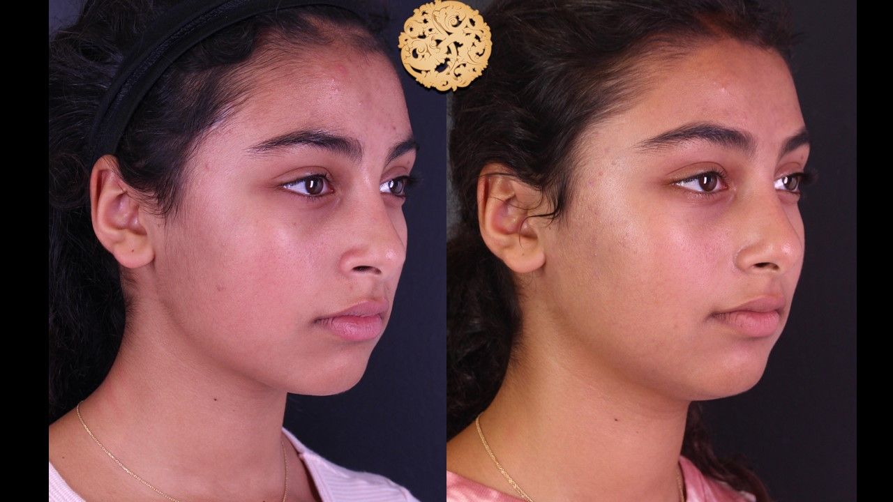 Bbl Laser Acne Before & After