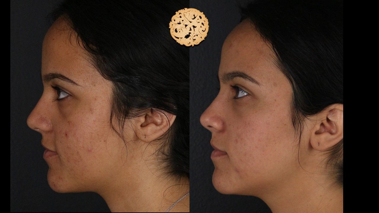 BBL Laser Acne Before & After