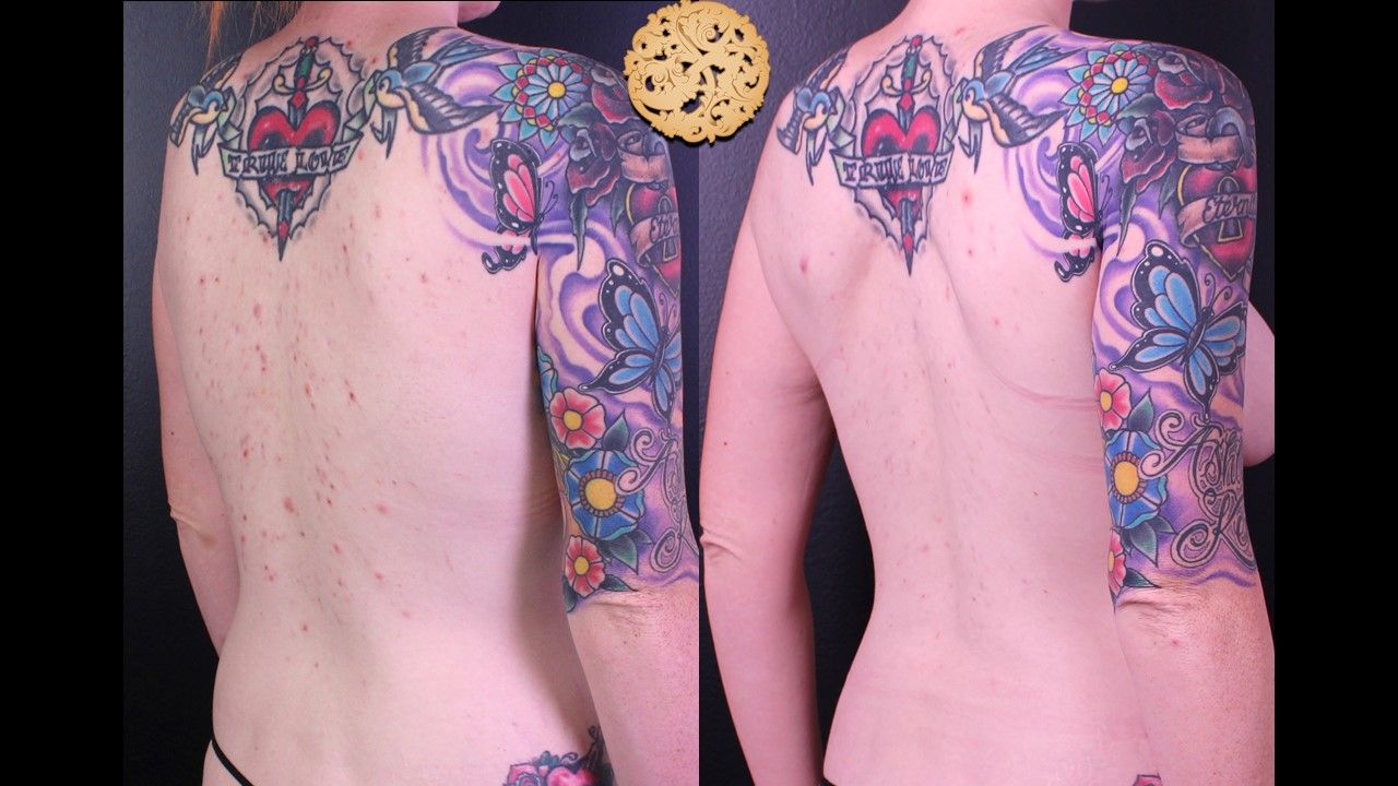 Bbl Laser Acne Before & After