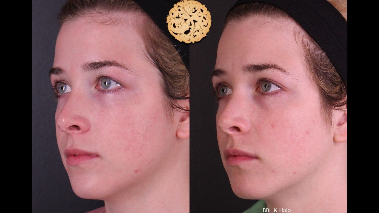 BBL Laser Acne Before & After