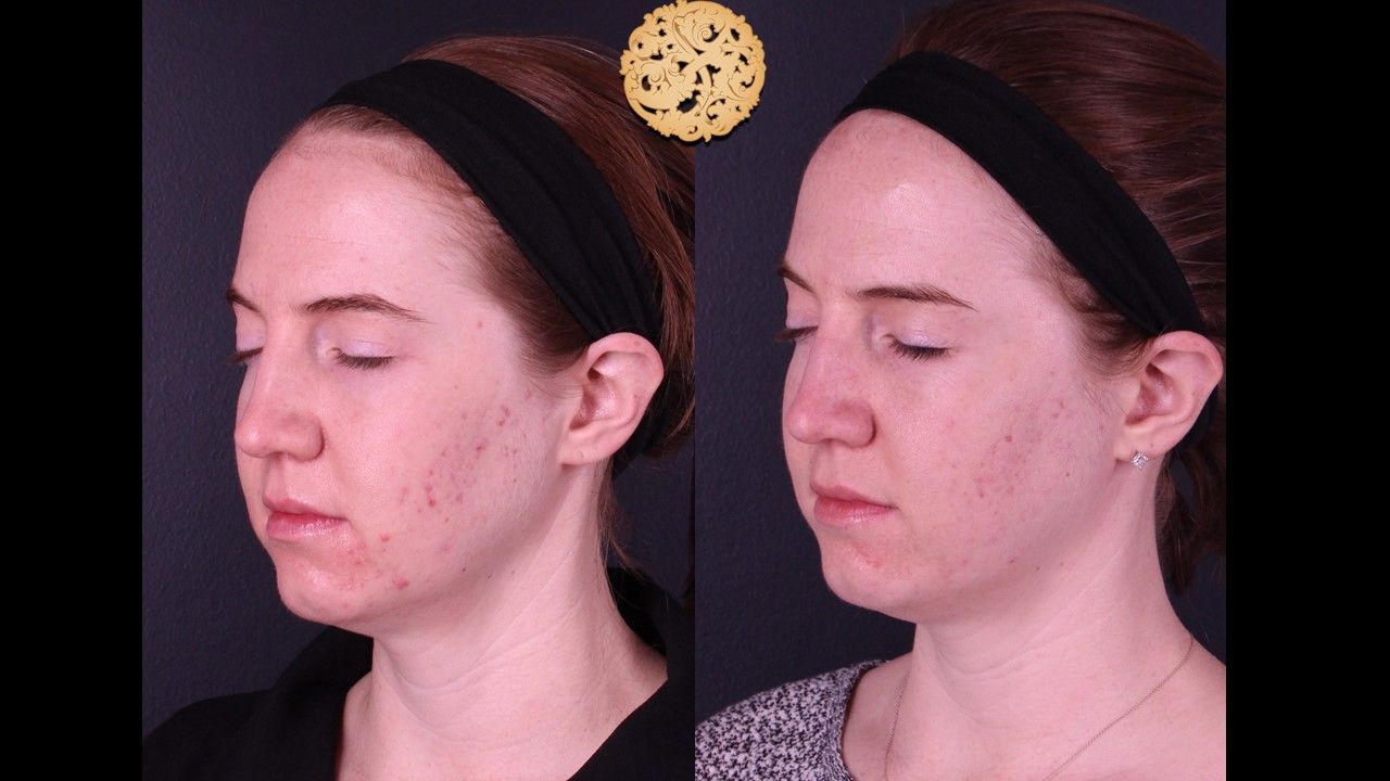 BBL Laser Acne Before & After