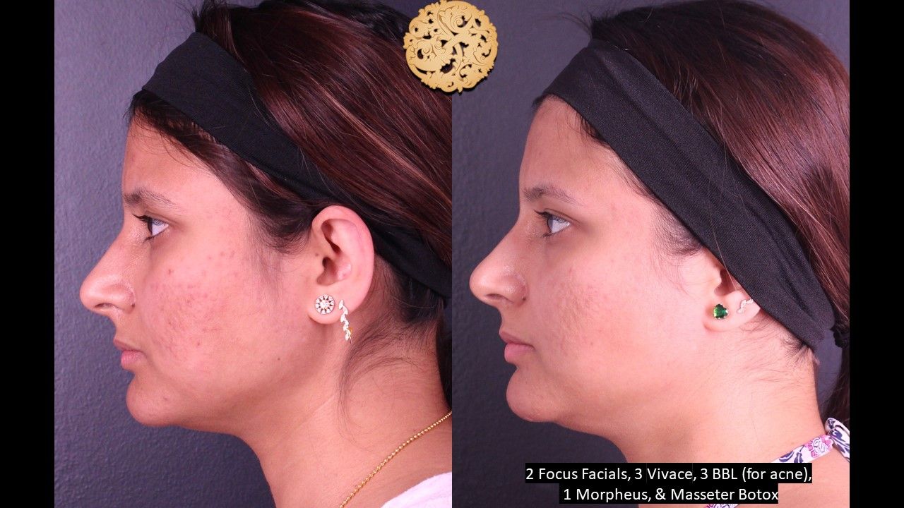 BBL Laser Acne Before & After