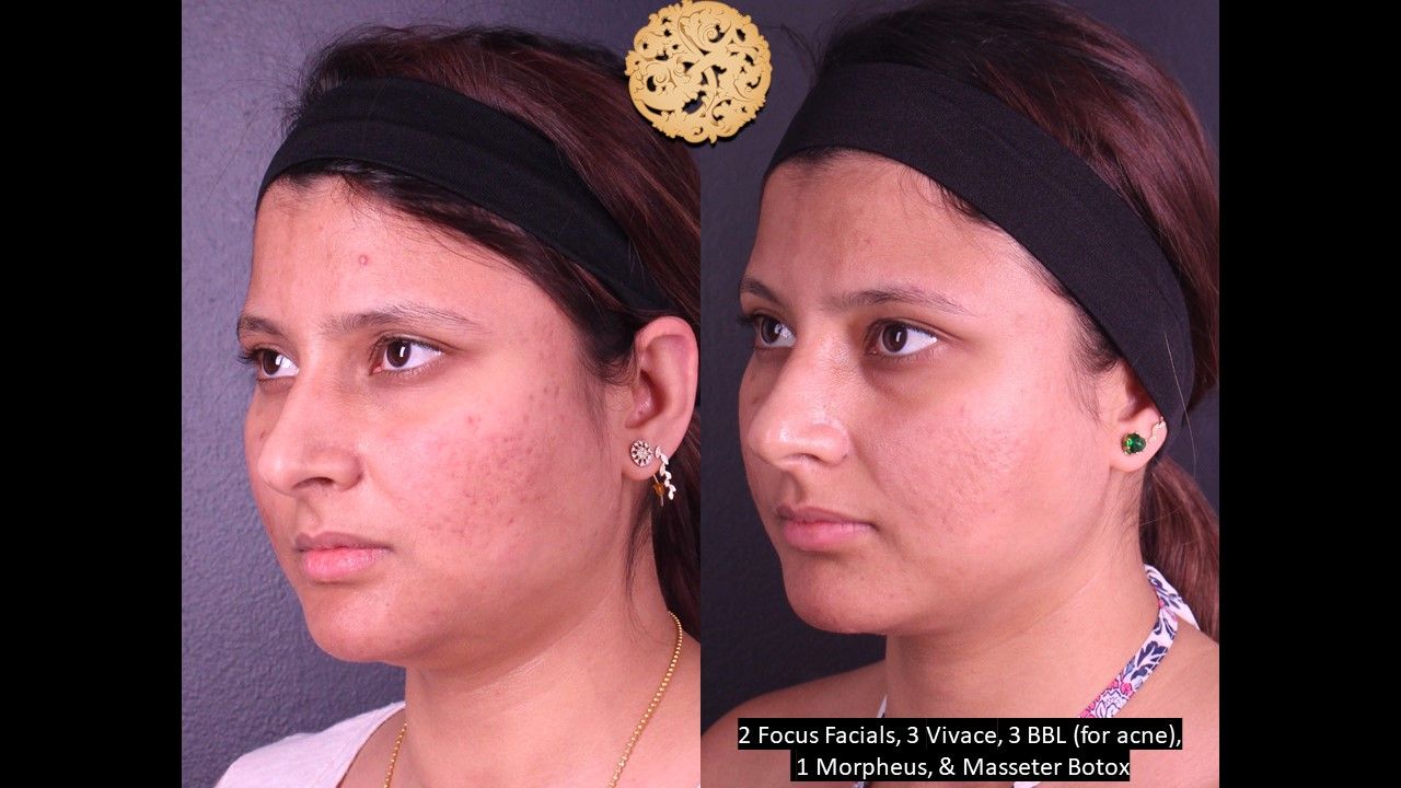 BBL Laser Acne Before & After