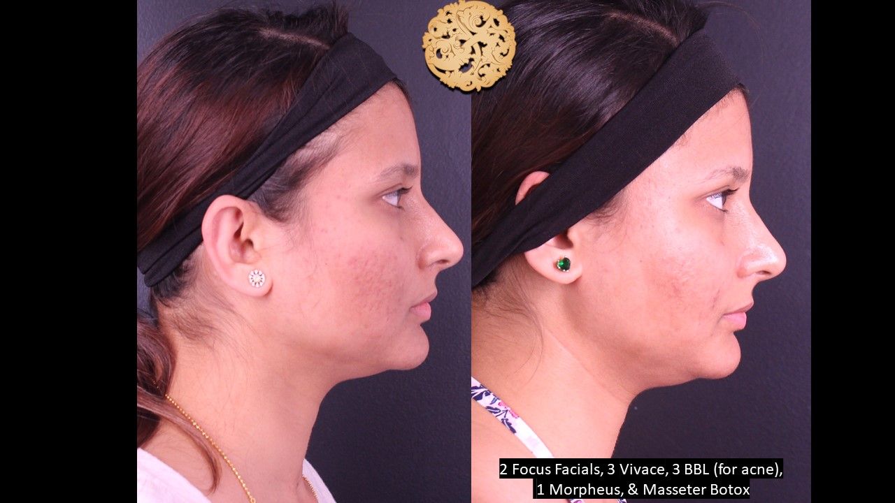 Bbl Laser Acne Before & After