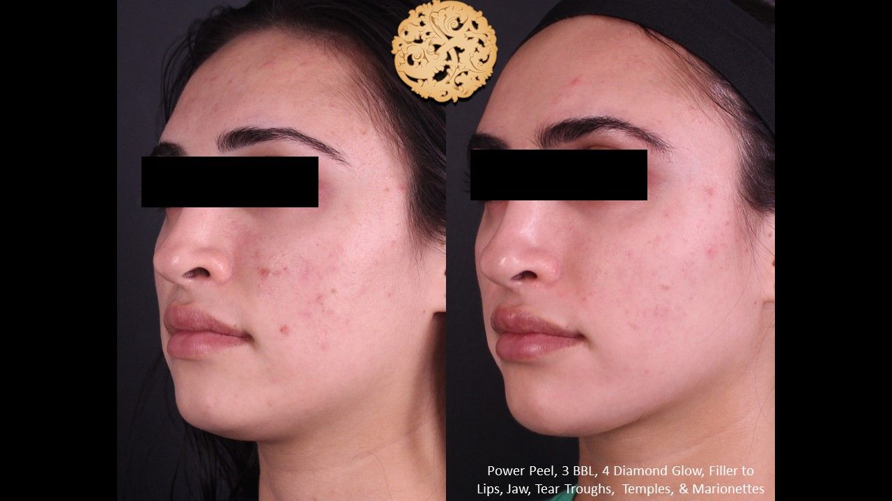 BBL Laser Acne Before & After