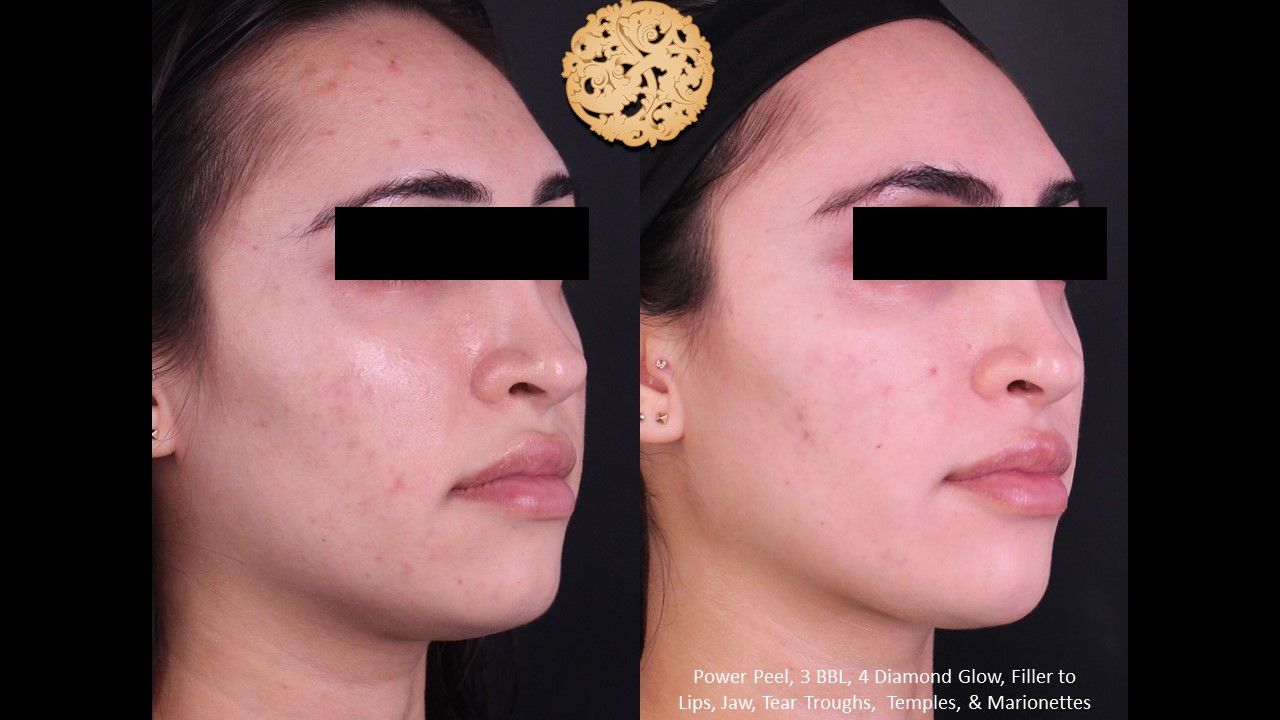 Bbl Laser Acne Before & After