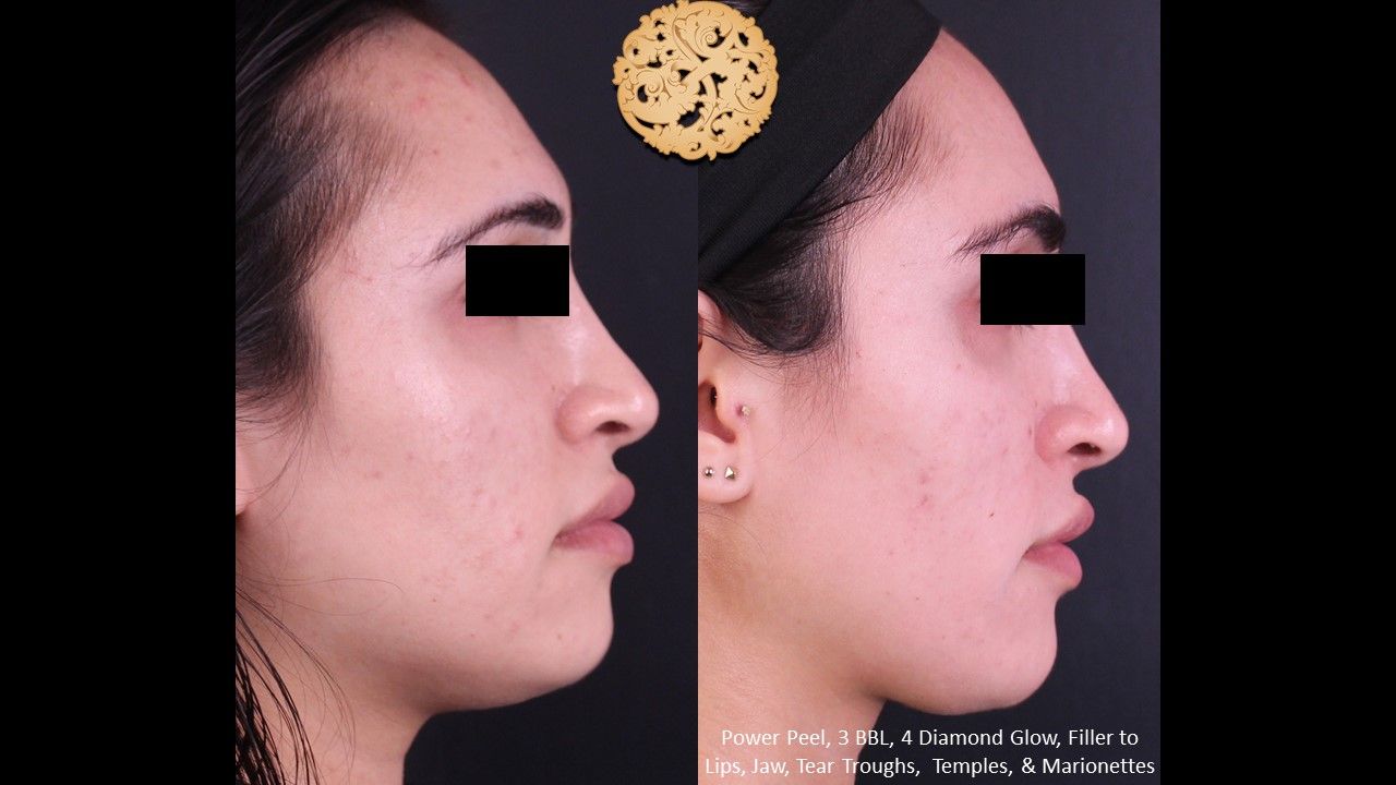 Bbl Laser Acne Before & After