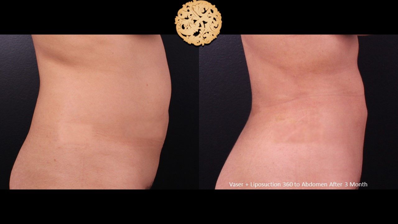 Vaser Before & After