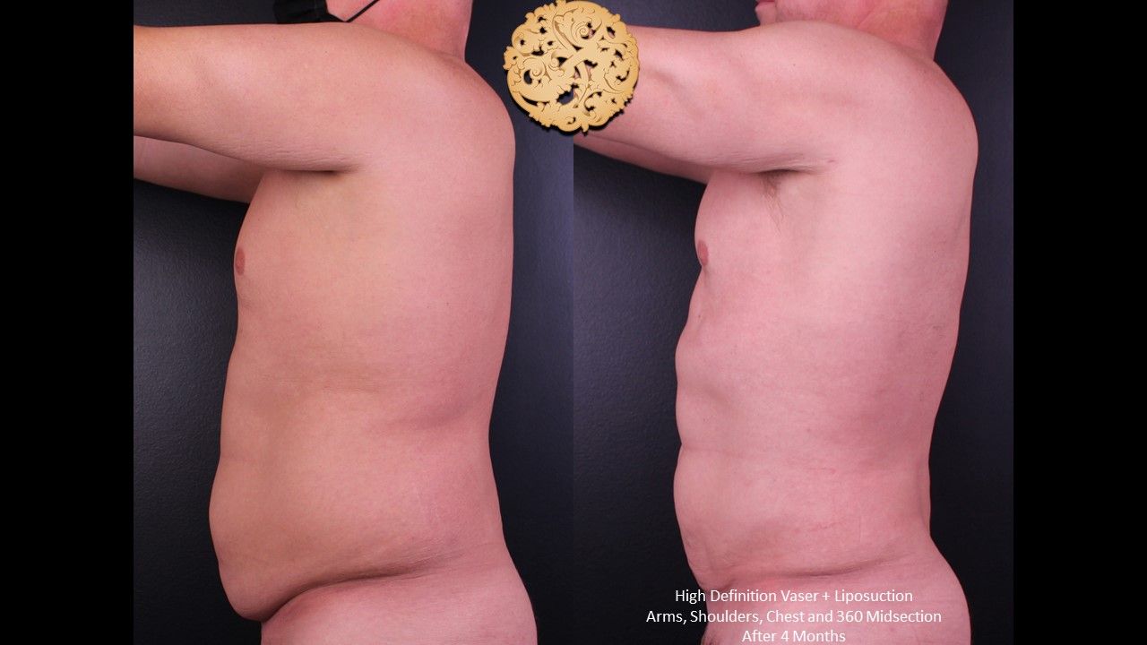 Vaser Before & After