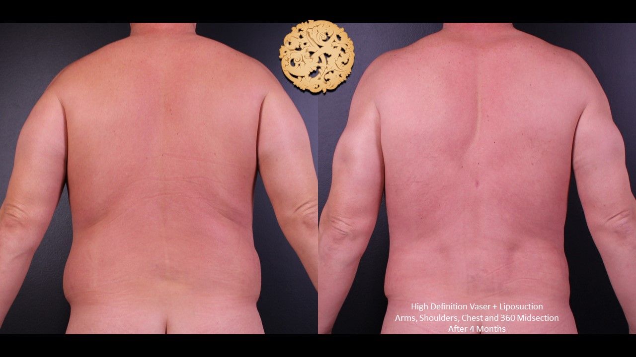 Vaser Before & After