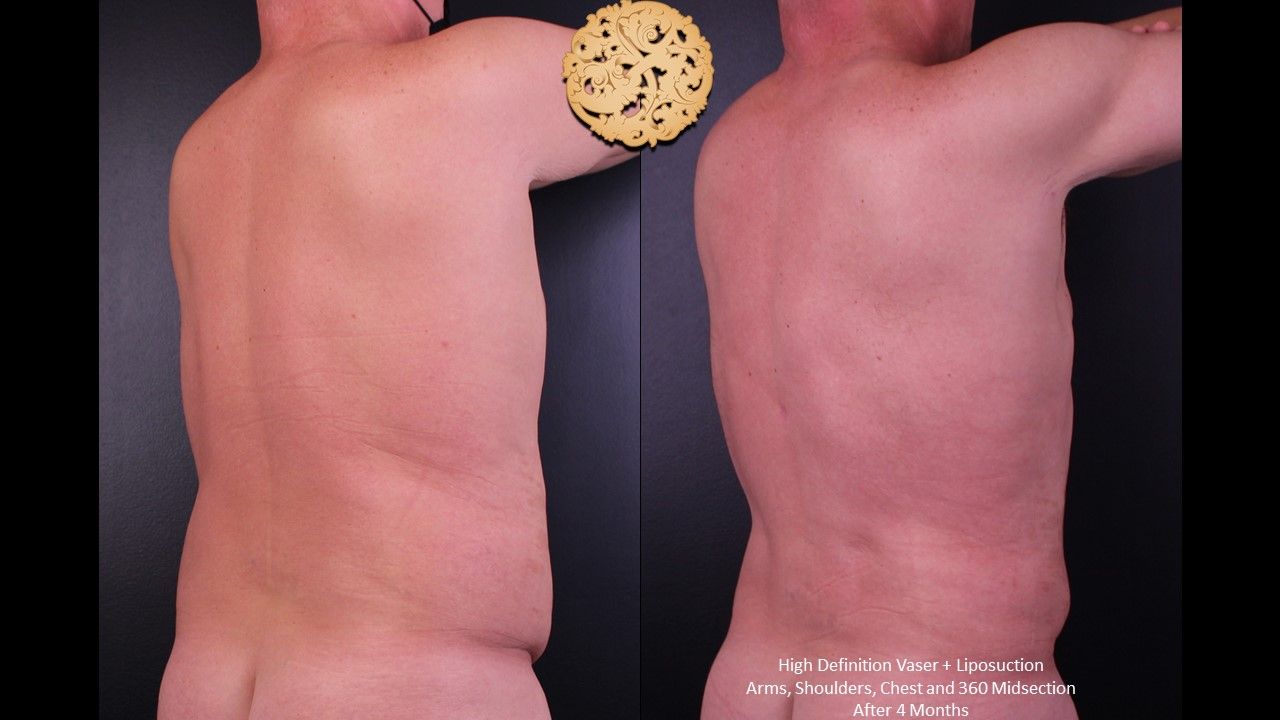 Vaser Before & After