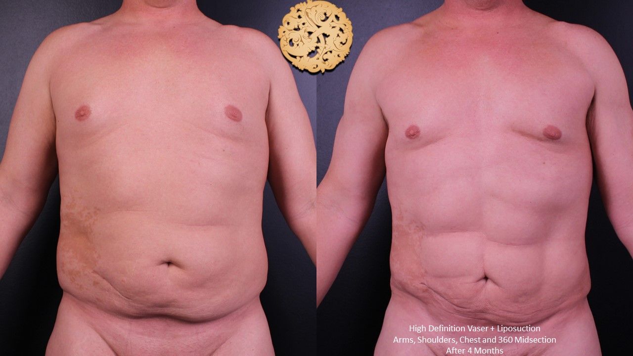 Vaser Before & After