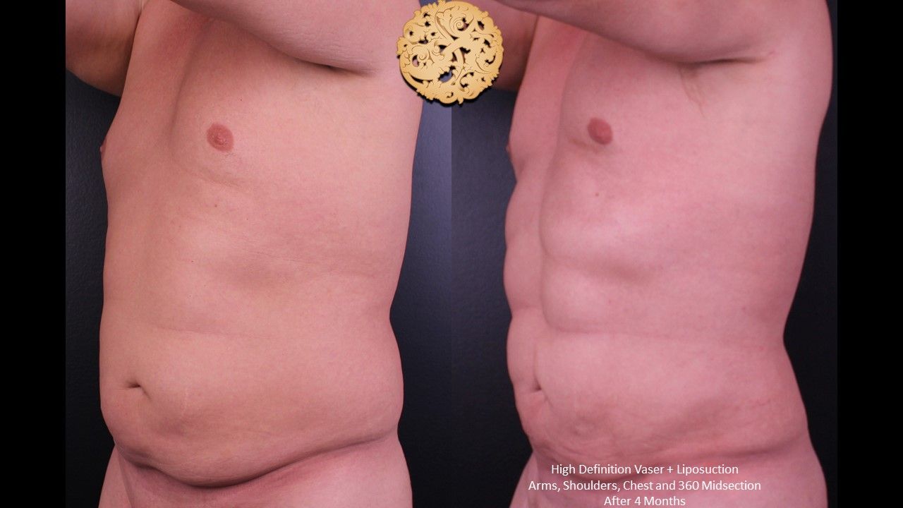 Vaser Before & After