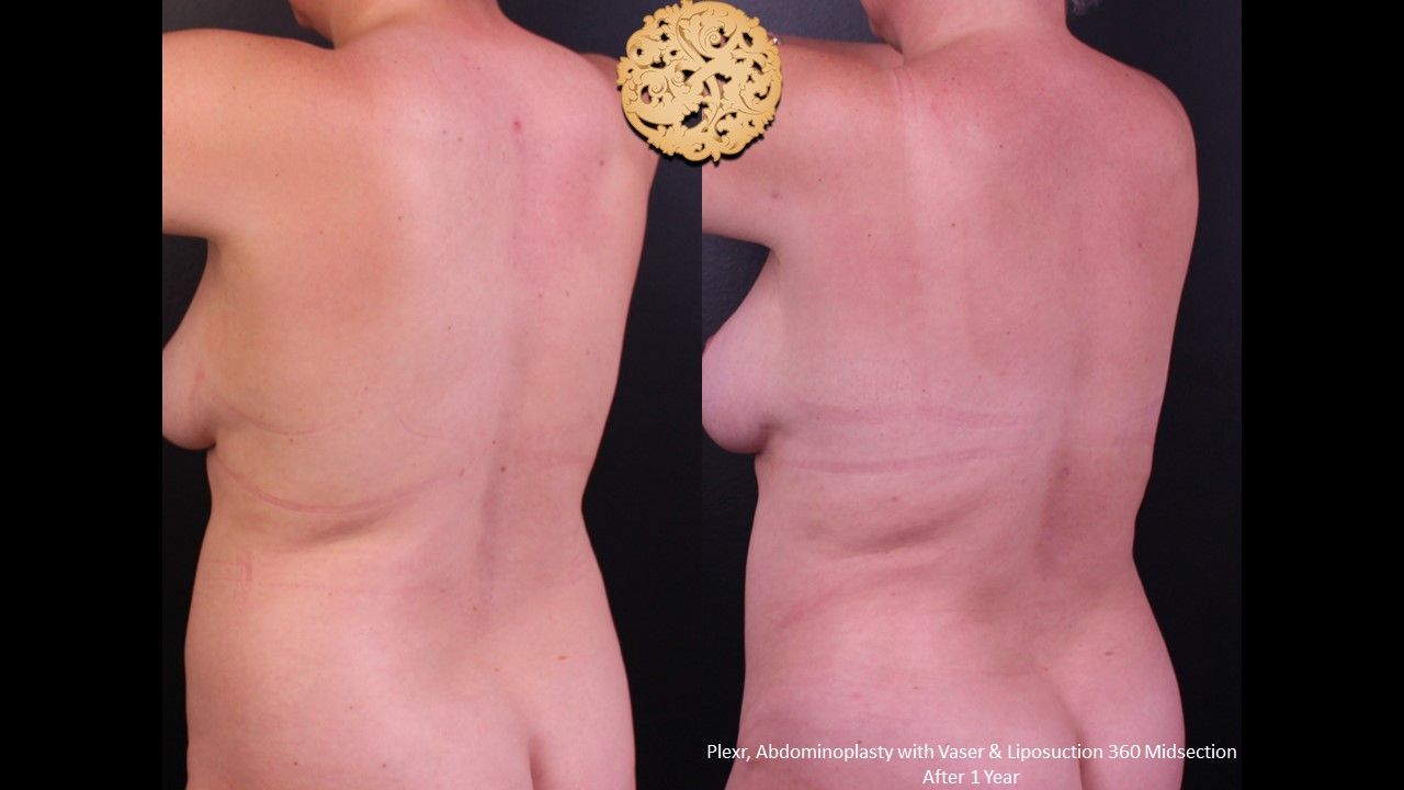 Vaser Before & After