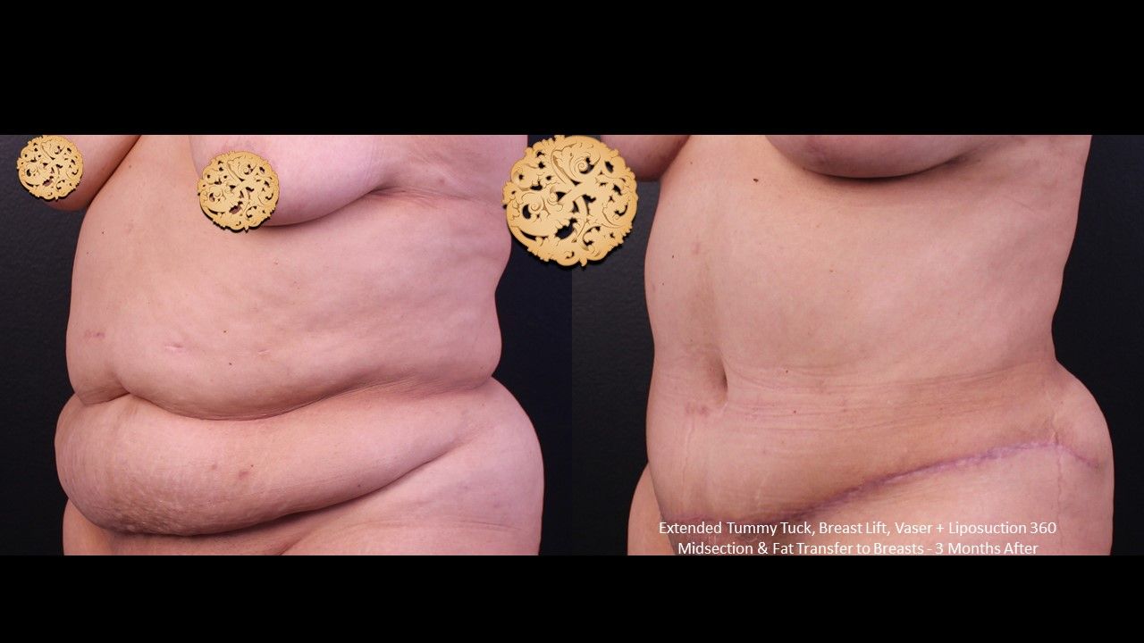 Vaser Before & After