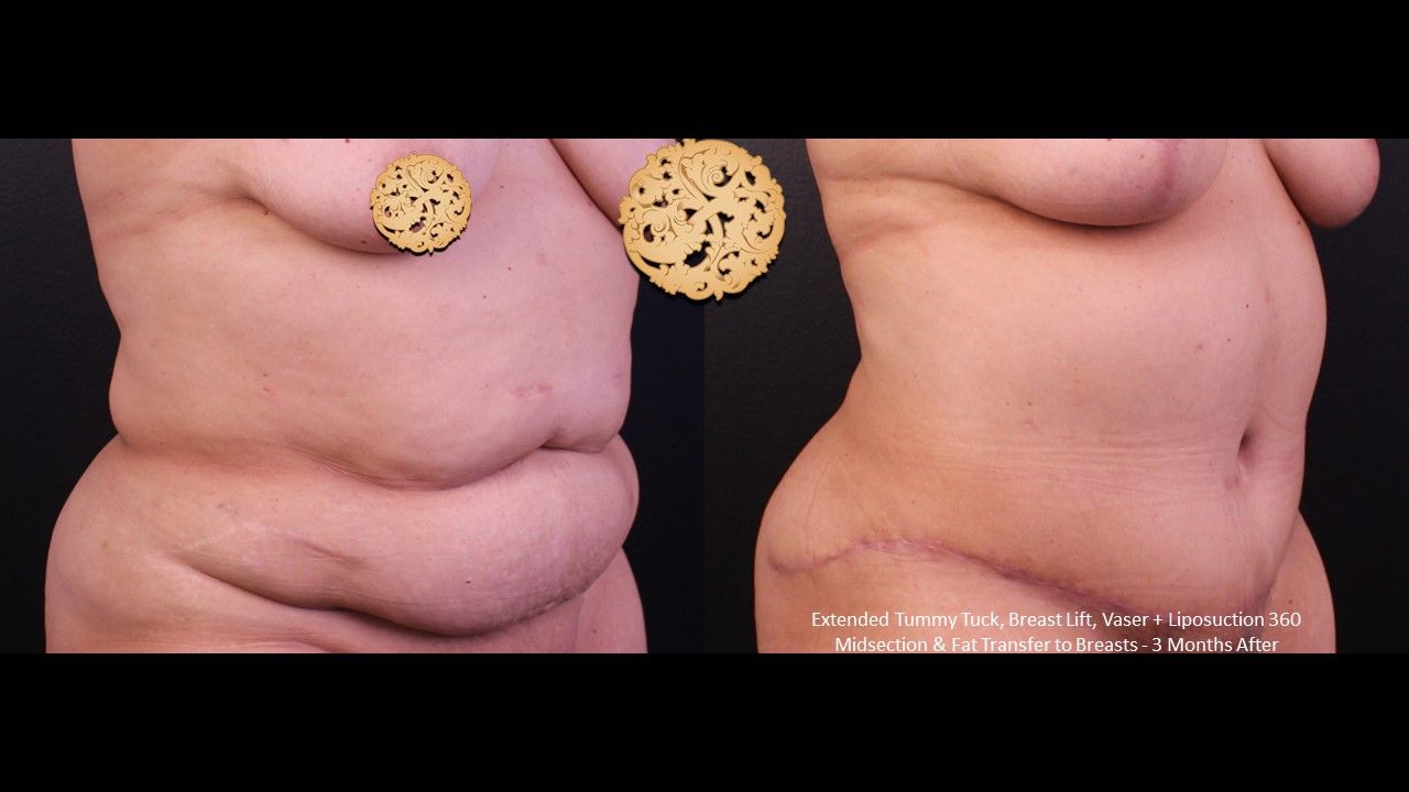 Vaser Before & After