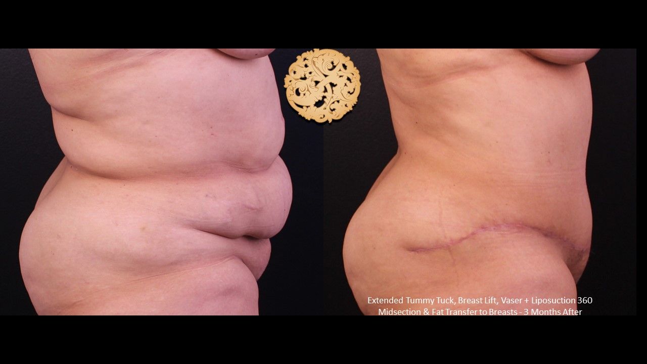 Vaser Before & After