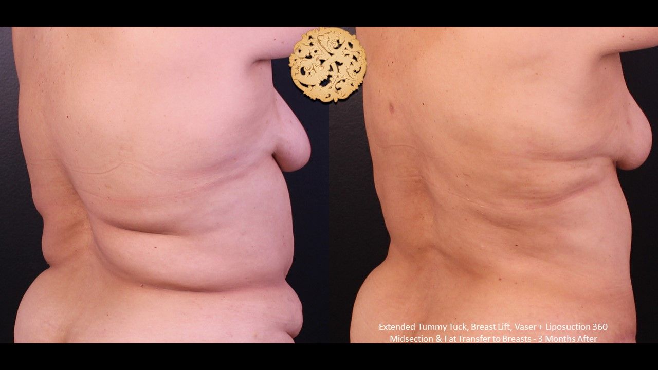 Vaser Before & After