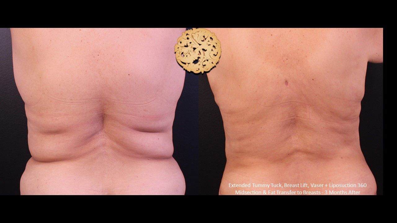 Vaser Before & After