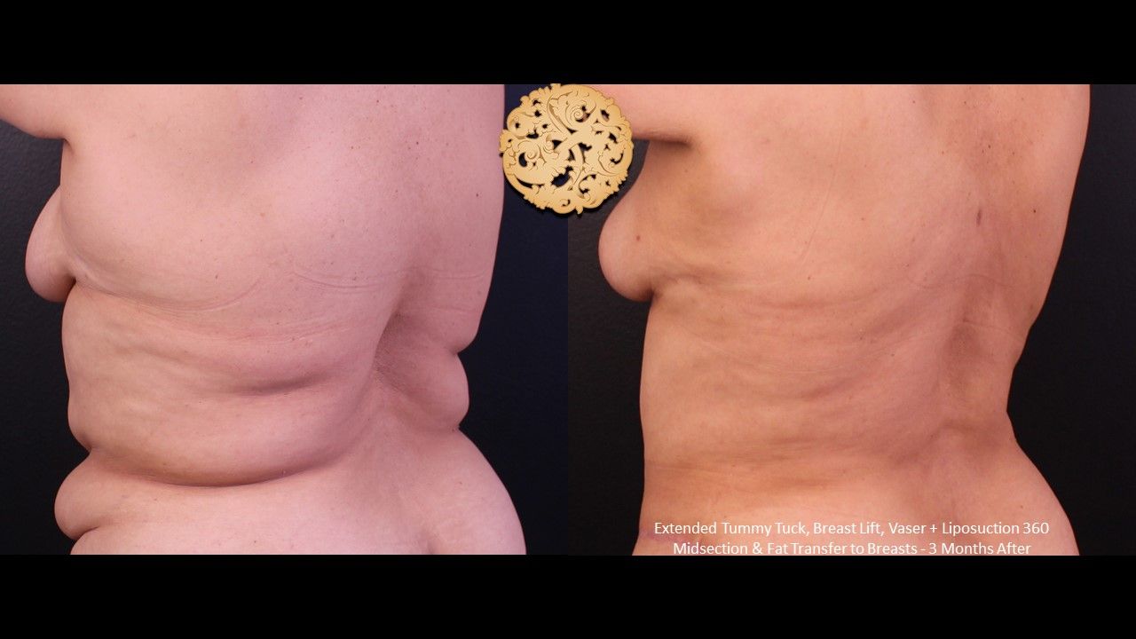 Vaser Before & After