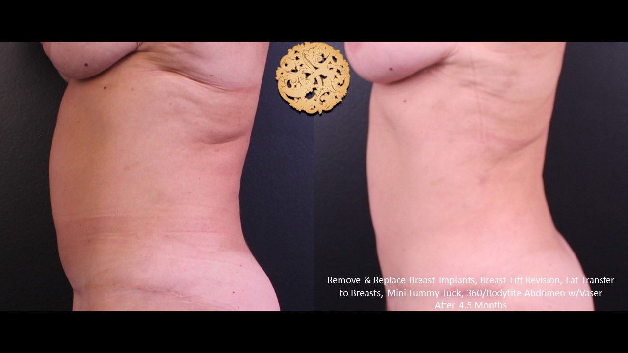 Vaser Before & After