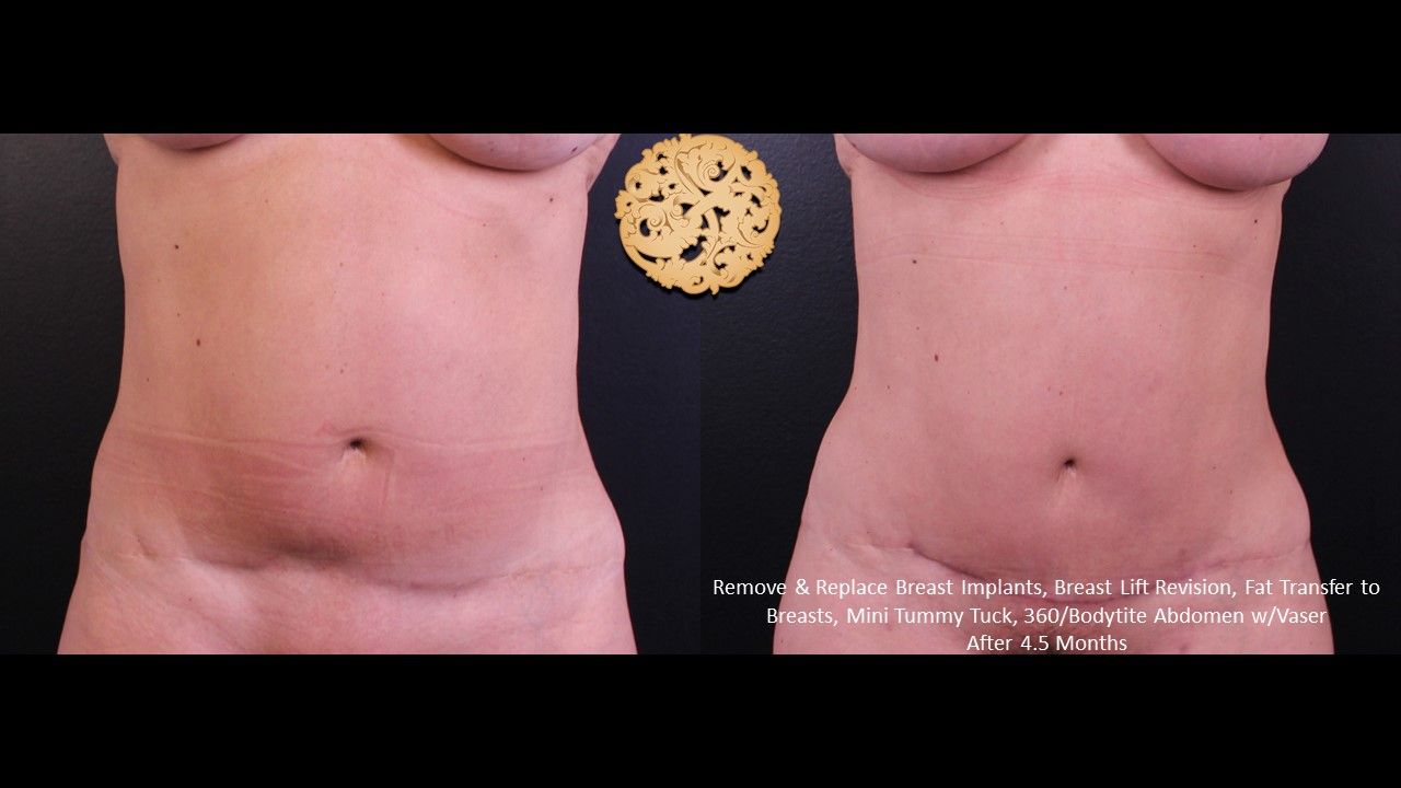 Vaser Before & After