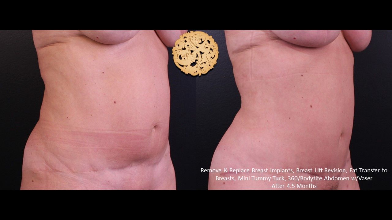 Vaser Before & After